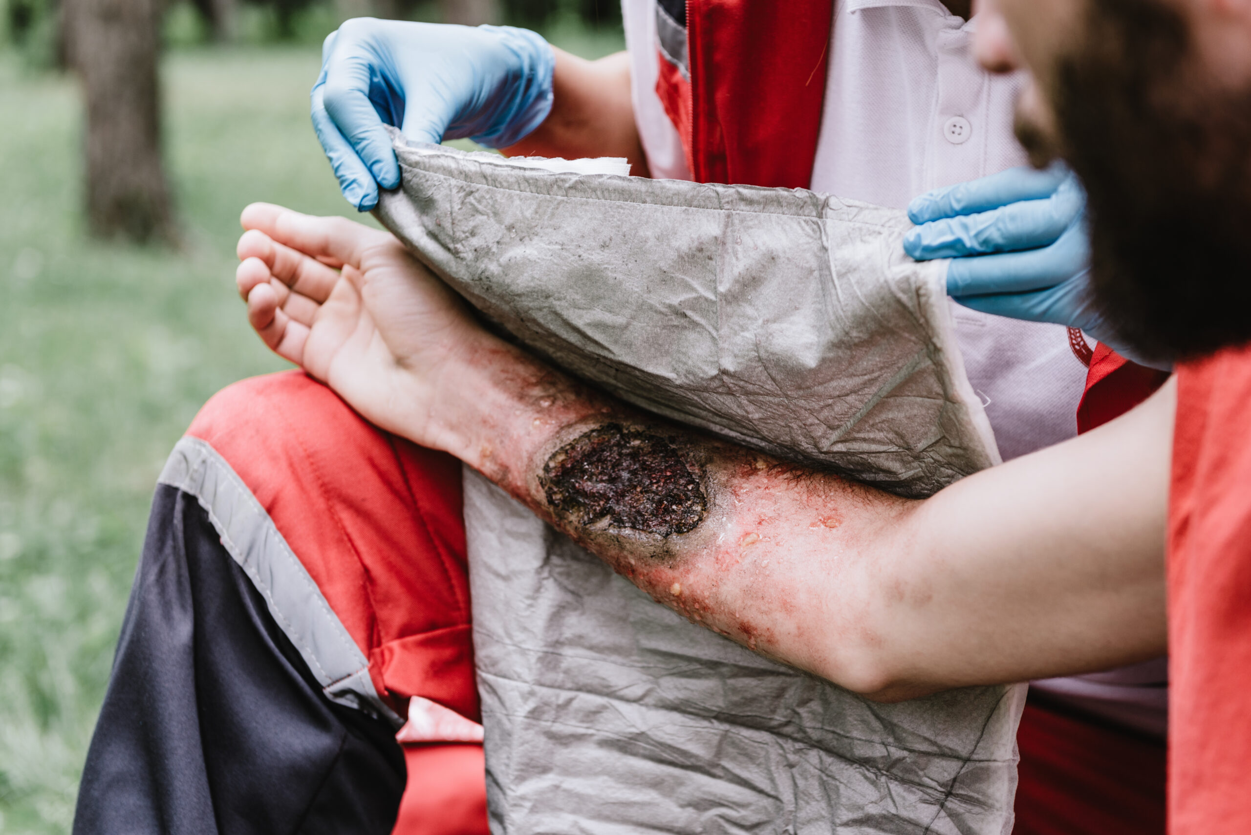 Compensation For Victims of Electrocution, Fire, and Burn Injuries